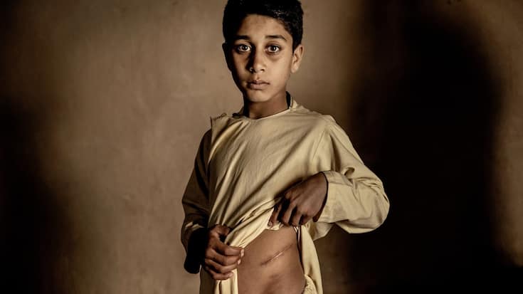 World Press Photo 2023 - Khalil Ahmad dont les parents ont décidé de vendre un de ses deux reins pour 3500 dollars